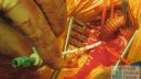 Amplatzer 1 deployment in subclavian artery